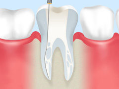 重度の虫歯を抜かずに治す「根管治療」