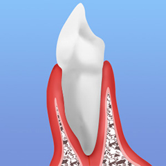 歯周病は骨を溶かし、やがて歯が抜けてしまいます