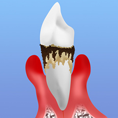 歯周病は骨を溶かし、やがて歯が抜けてしまいます